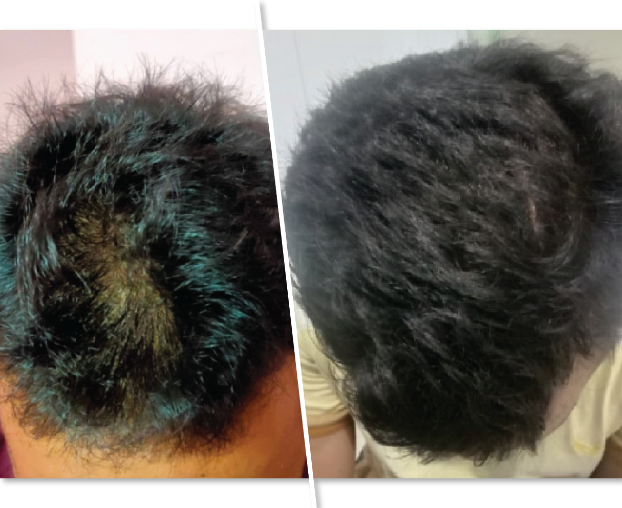 Hair Fall Treatment Before and After Picture
